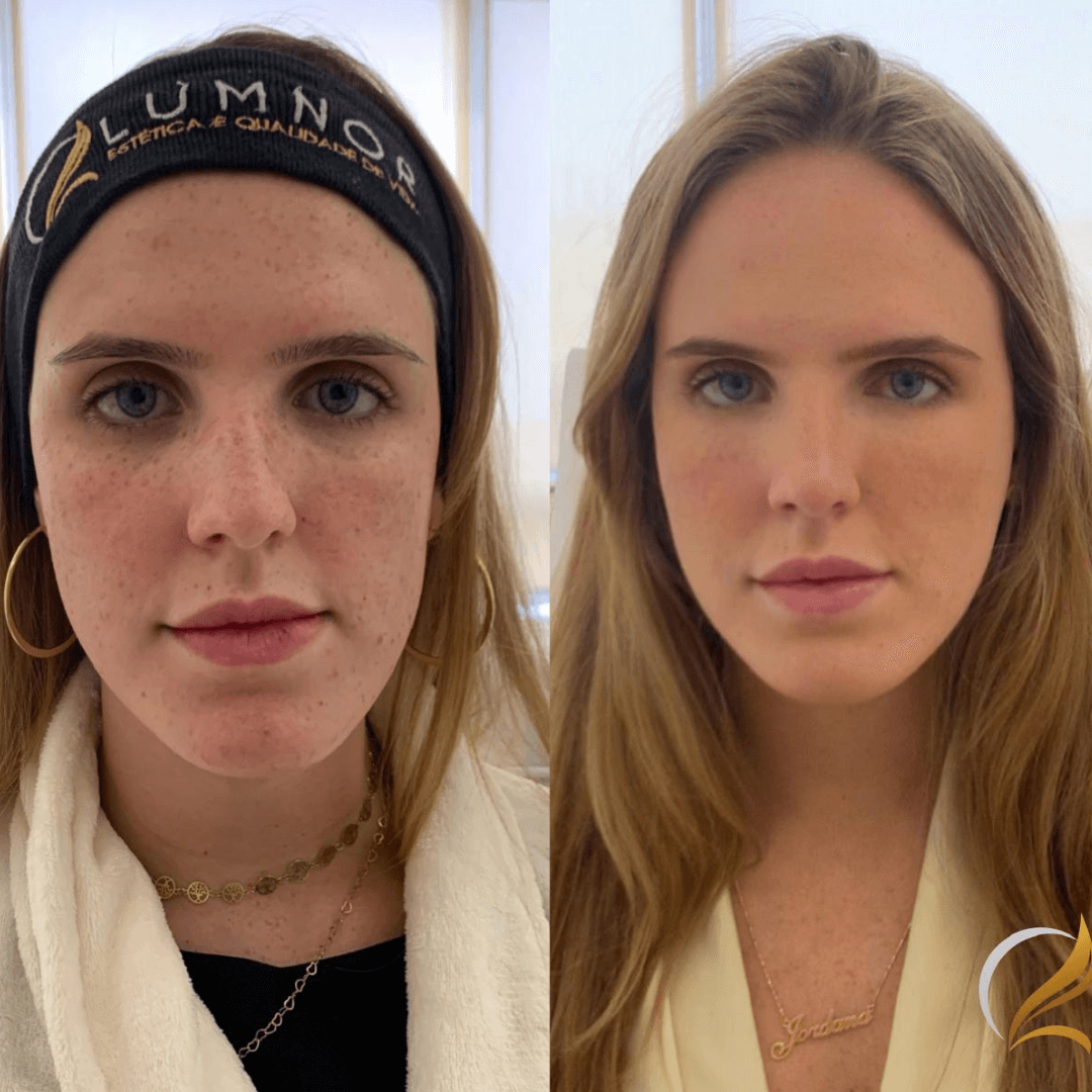 Resultados harmonização full face 1