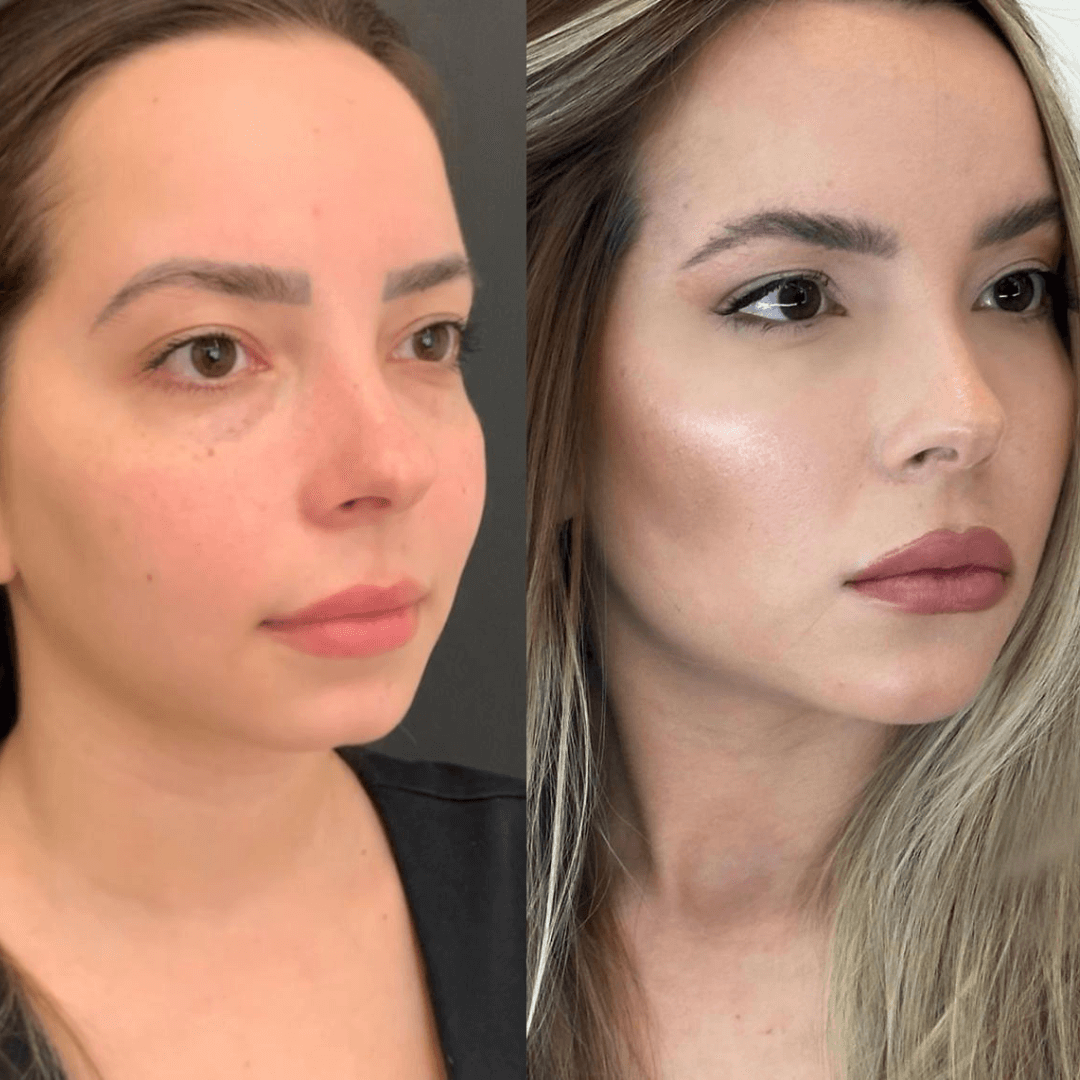 Resultados harmonização full face 10