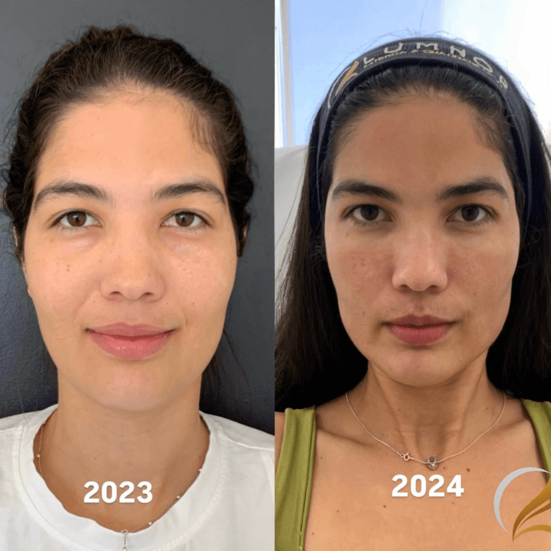 Resultados harmonização full face 11