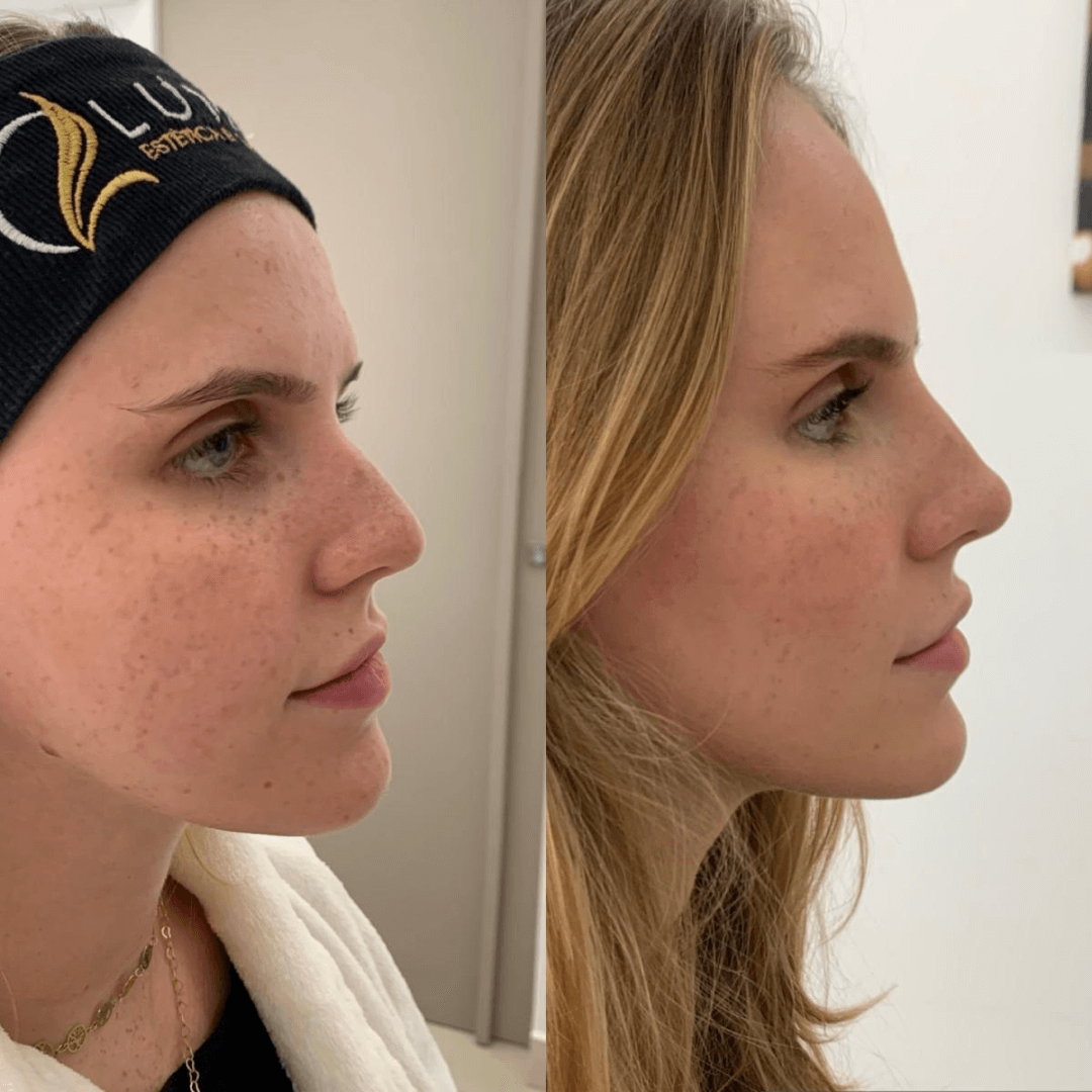Resultados harmonização full face 2