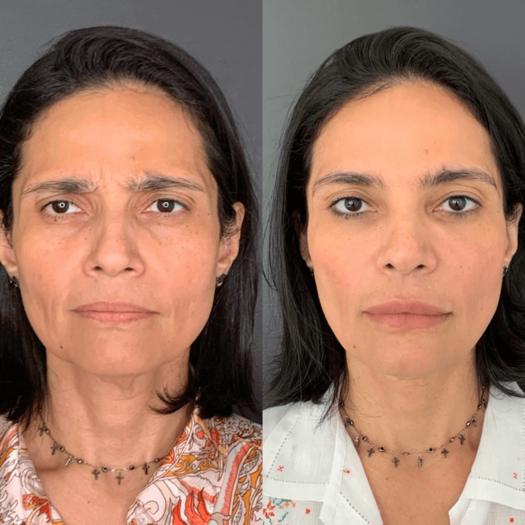 Resultados harmonização full face 3