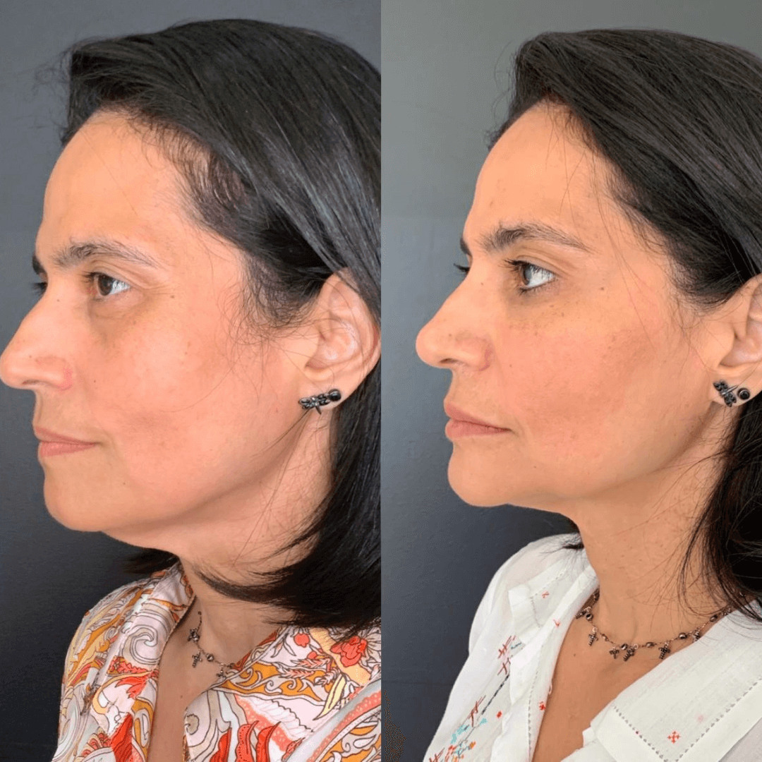 Resultados harmonização full face 4