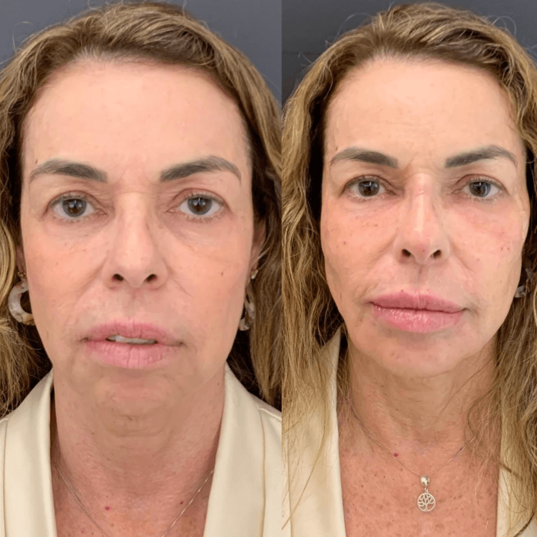 Resultados harmonização full face 5