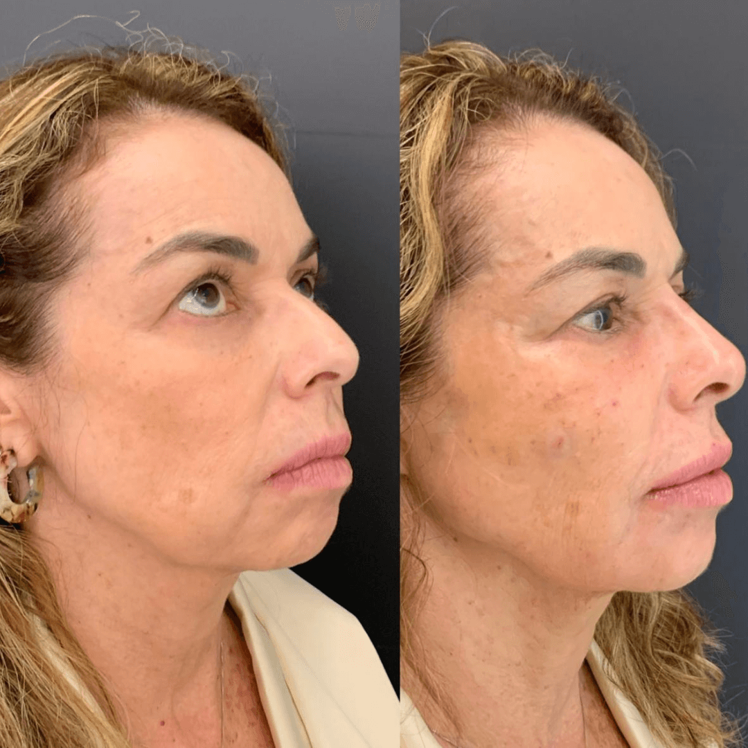 Resultados harmonização full face 6