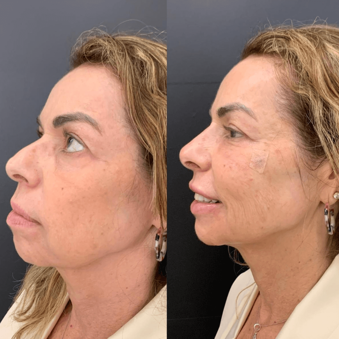 Resultados harmonização full face 7
