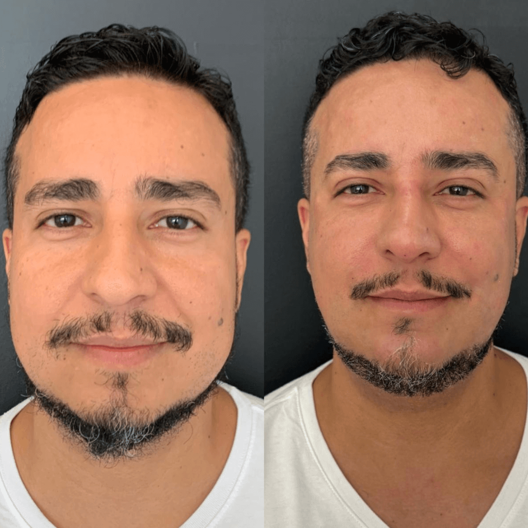 Resultados harmonização full face 8