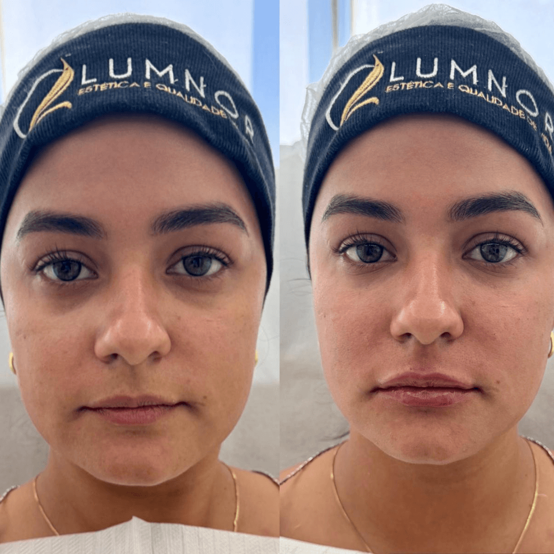 Resultados harmonização full face 9